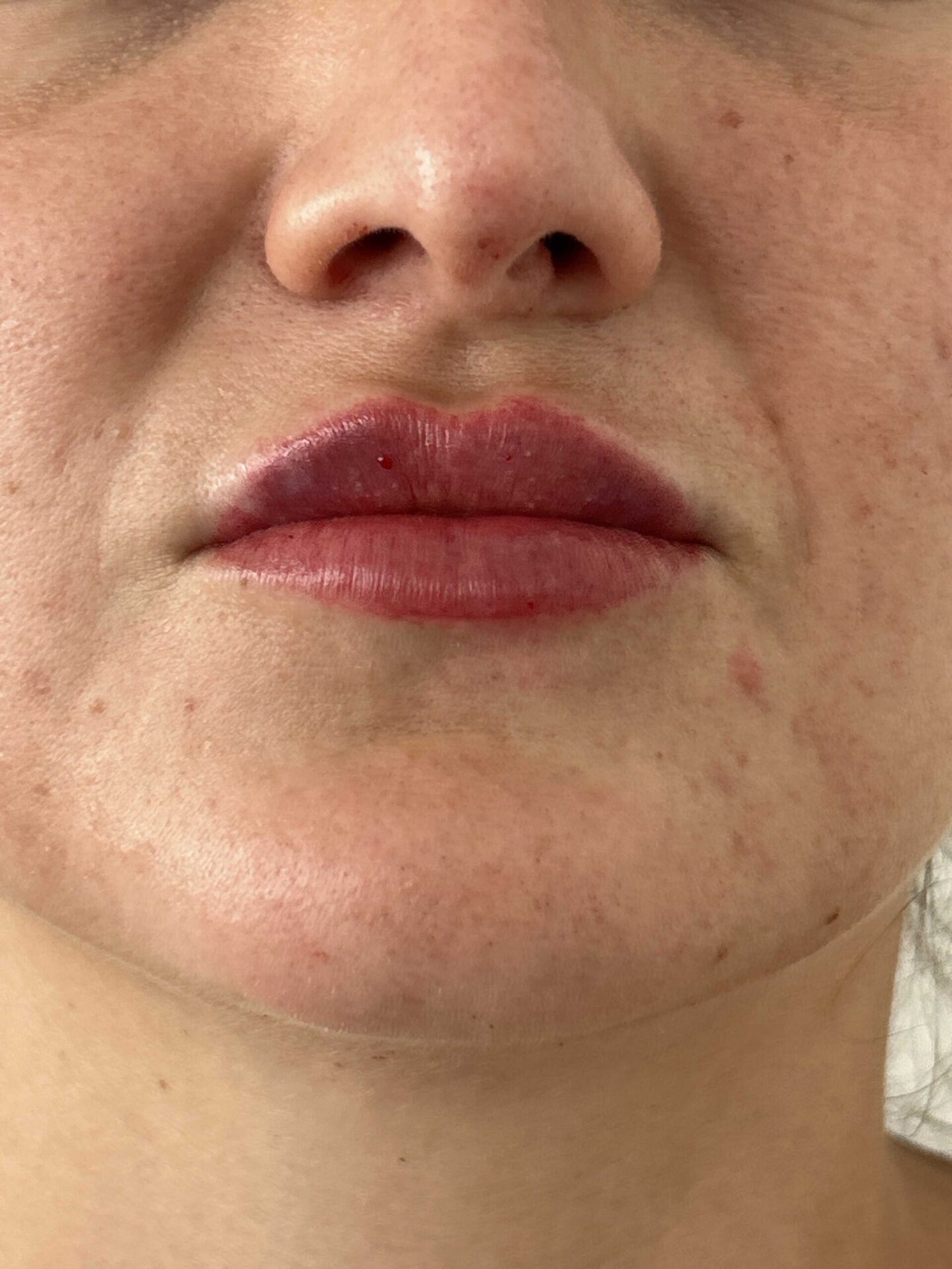 Lipfiller after